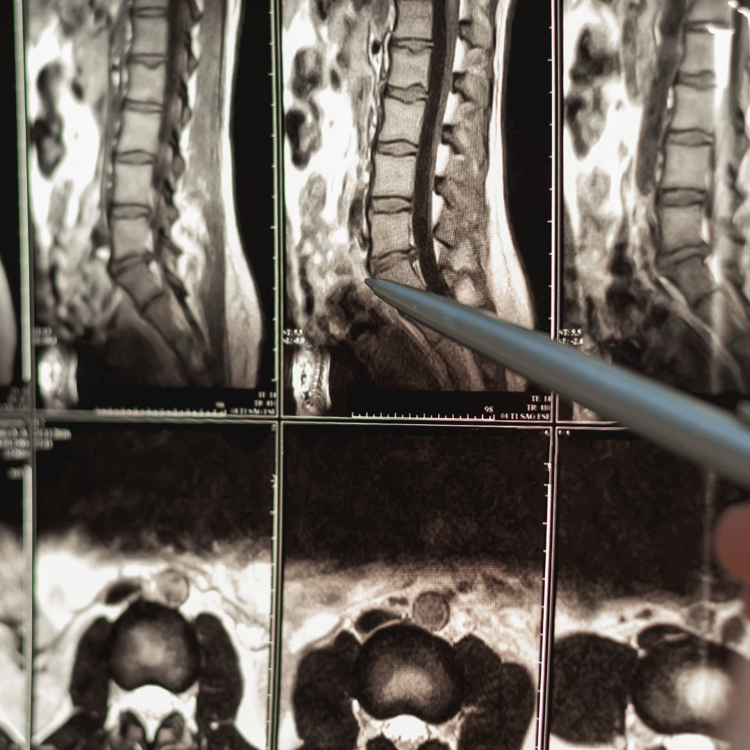 Spinal-cord-injury-attorney-stephen-stewart